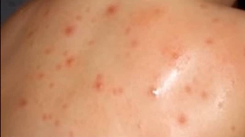 Registrovan prvi slučaj majmunskih boginja u Srbiji