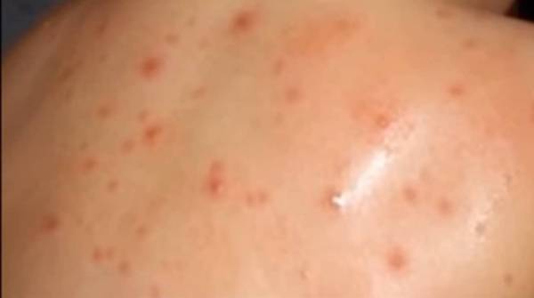 Registrovan prvi slučaj majmunskih boginja u Srbiji