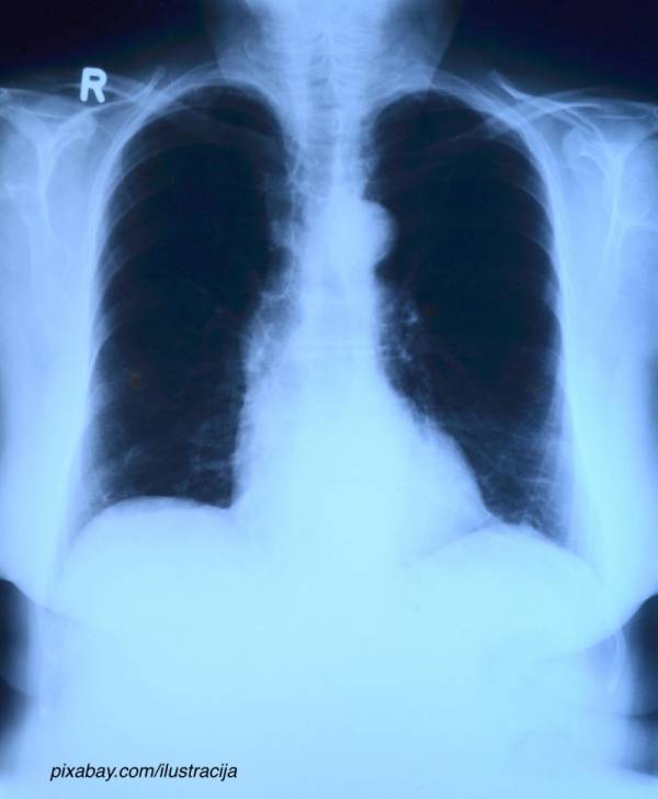 Rast broja obolelih od raka pluća, prevencija bitna