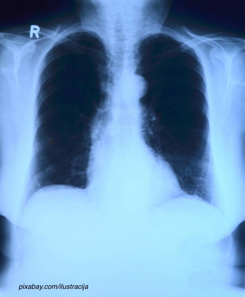 Rast broja obolelih od raka pluća, prevencija bitna